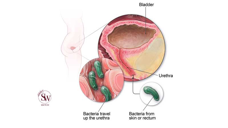 What Causes Urinary Tract Infection?