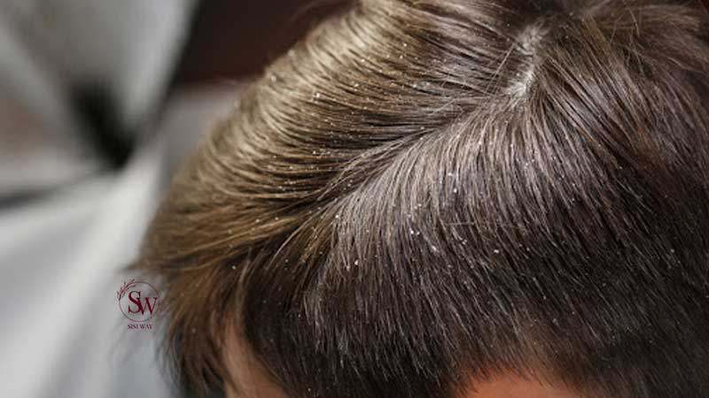 dandruff-and-hair-loss