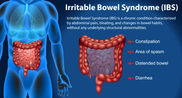Understanding the Causes of IBS