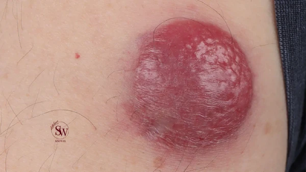What is Merkel Cell Carcinoma?